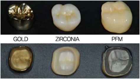 tensile strength zirconia|zirconia crown strength.